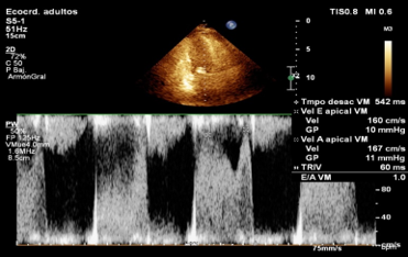 Fig. 2 - Ecocardiograma Doppler de válvula mitral (VM). Muestra los elementos auscultatorios de los cambios del ciclo cardiaco en la estenosis mitral crítica.