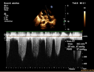 Fig. 3 - Eje 4 cámaras desde el ápex de ecocardiograma doppler. Se observa una elevación de las presiones en el ventrículo derecho que infiere la hipertensión pulmonar grave: Gradiente de presión máximo de 47 mmHg y Presión sistólica del Ventrículo Derecho de 57 mm Hg
