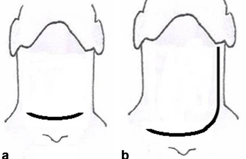 Incisiones
para procedimientos quirúrgicos en la glándula tiroides: a) Kocher
. b) Eckert & Byars o en “Palo de Hockey”.
Esquema elaborado por el autor principal.