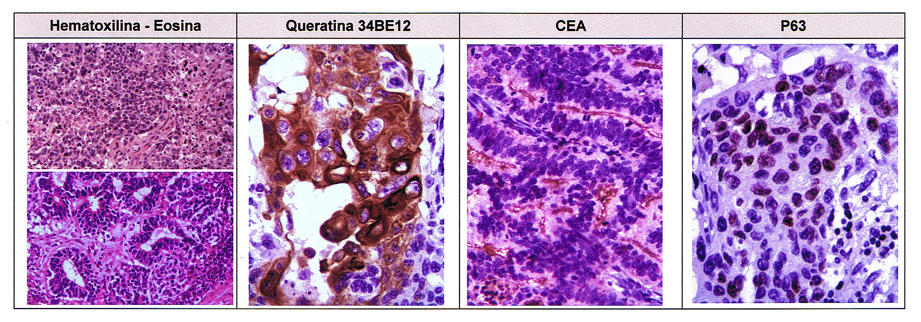 Inmunohistoquímica. Muestra histología tumoral (aumento 10X, tinción:
hematoxilina y eosina). Positividad para citoqueratina, 34BE12, antígeno
carcinoembrionario (CEA) y P63.