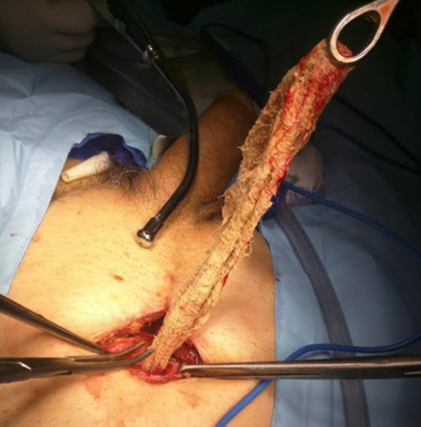 Extracción de gasa quirúrgica retenida,
mediante cistotomía