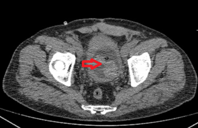 Hallazgos tomográficos de gossypiboma en vejiga