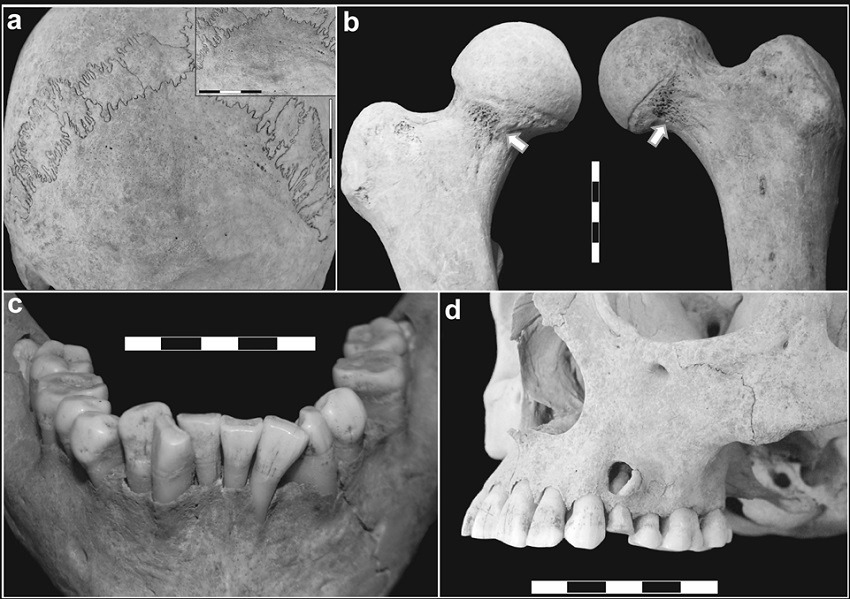 Principales indicadores osteológicos identificados en
LP-I. a) hiperostosis porótica leve en occipital; b)
cribra femoralis en ambos cuellos
de fémur (flechas); c) apiñamiento
de la dentición anterior inferior; d)
atrición y lesión periapical del primer premolar superior izquierdo; retracción alveolar de la arcada dental posterior