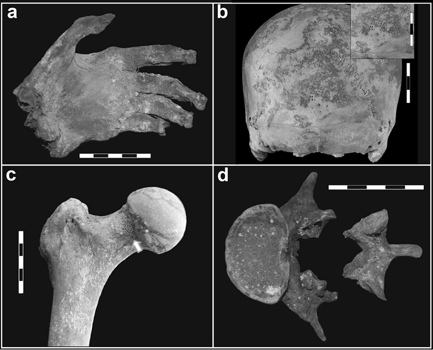 Principales indicadores identificados en LP-II. a) Mano izquierda momificada con tinción verde; b) hiperostosis
porótica en occipital; c) cribra femoralis en cuello femoral
derecho (flecha); d)
espondilolistesis de la quinta lumbar