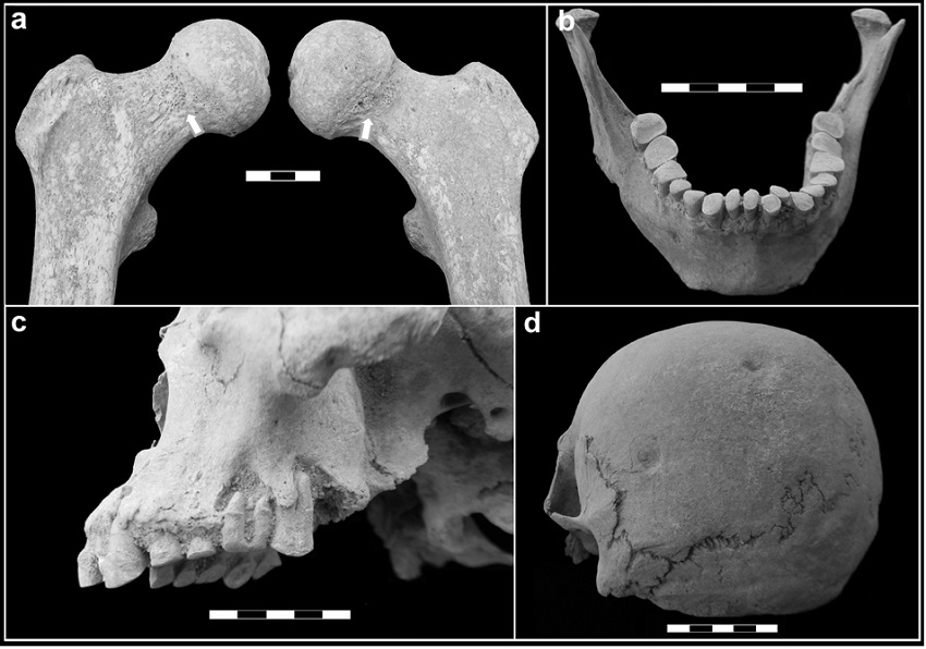 Principales indicadores osteológicos identificados en
LP-III. a)Cribra femoralis en ambos cuellos de fémur (flecha); b) apiñamiento
dental anterior leve; c) retracción alveolar generalizada, exposición
de la cavidad pulpar y reacción periapical en la dentición posterior; d) traumas localizados y remodelados en
parietal izquierdo.