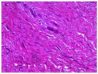 Caso 1. Imagen
microscópica de  

fibrosarcoma, obsérvese
fibroblastos con núcleo  

hipercromático, alargado u
ovalado y algunos  

fibroblastos multinucleados
(H-E, 40x)