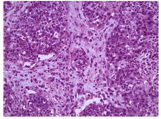 Caso 2. Imagen
microscópica de  

fibrosarcoma metastásica en
ganglio mesentérico, nótese los micronódulos neoplásicos rodeadas de tejido
linfoide (H – E, 40x)