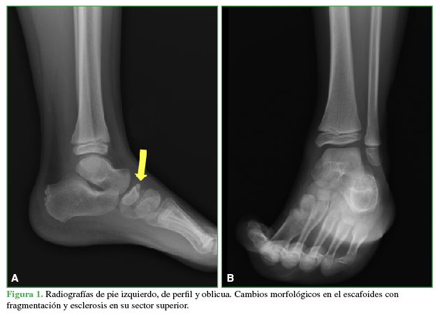 Radiografías de pie izquierdo, de perfil y oblicua. Cambios morfológicos en el escafoides con fragmentación y esclerosis en su sector superior.