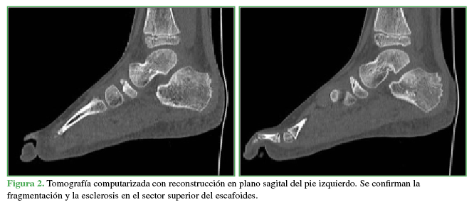 Tomografía computarizada con reconstrucción en plano sagital del pie izquierdo.
