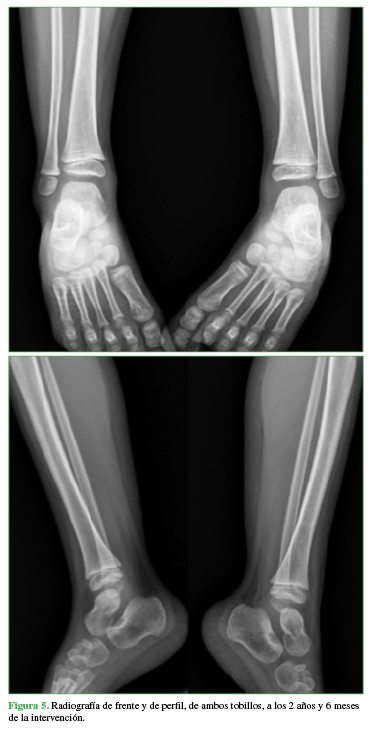 Radiografías de frente y de perfil, de ambos tobillos, a los 2 años y 6 meses de la intervención.