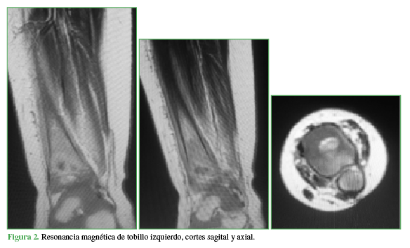 Resonancia magnética de tobillo izquierdo, cortes sagitales y axial.