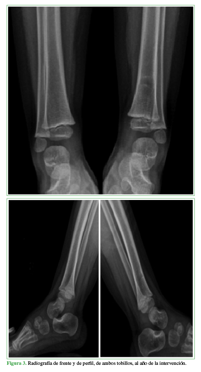 Radiografías de frente y de perfil, de ambos tobillos, al año de la intervención.