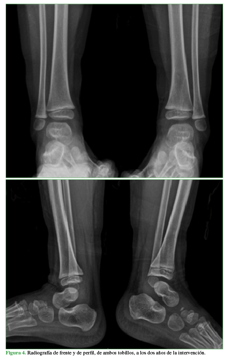 Radiografías de frente y perfil, de ambos tobillos, a los dos años de la intervención.