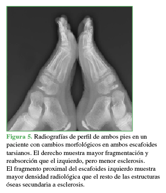 Radiografía de perfil de ambos pies en un paciente con cambios morfológicos en ambos escafoides tarsianos. El derecho muestra mayor fragmentación y reabsorción que el izquierdo, pero menor esclerosis. El fragmento proximal del escafoides izquierdo muestra mayor densidad radiológica que el resto de las estructuras óseas secundaria a esclerosis.
