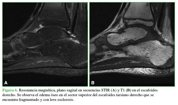 Resonancia magnética, plano sagital en secuencias STIR (A) y T1 (B) en el escafoides derecho. Se observa el edema óseo en el sector superior del escafoides tarsiano derecho que se encuentra fragmentado y con leve esclerosis.