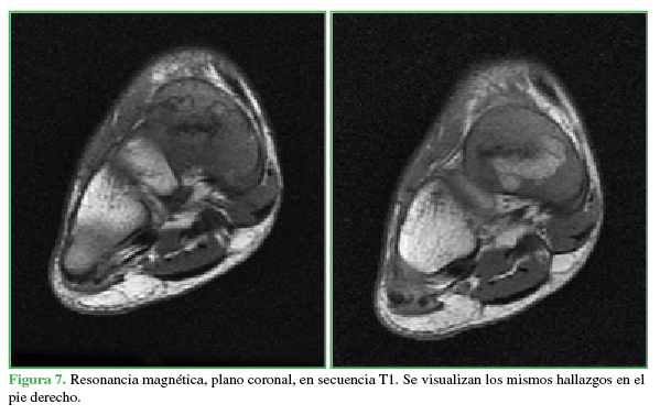 Resonancia magnética, plano coronal, en secuencia T1. Se visualizan los mismos hallazgos en el pie derecho.