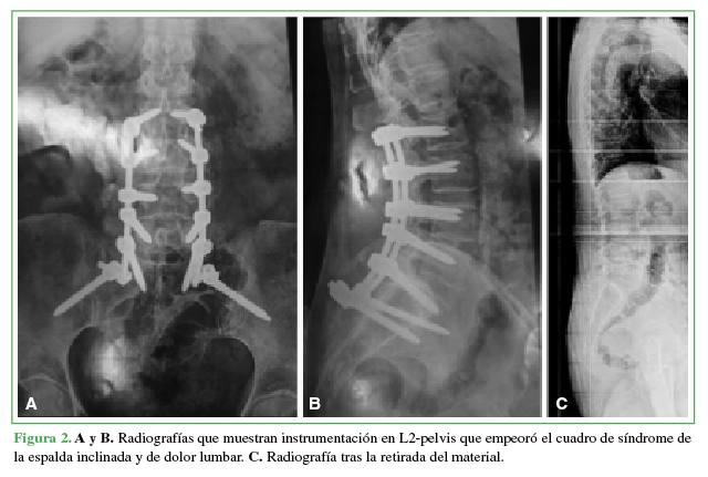 A y B.Radiografías que muestran instrumentación en L2-pelvis que empeoró el cuadro de síndrome de la espalda inclinada y de dolor lumbar. C. Radiografía tras la retirada del instrumental.