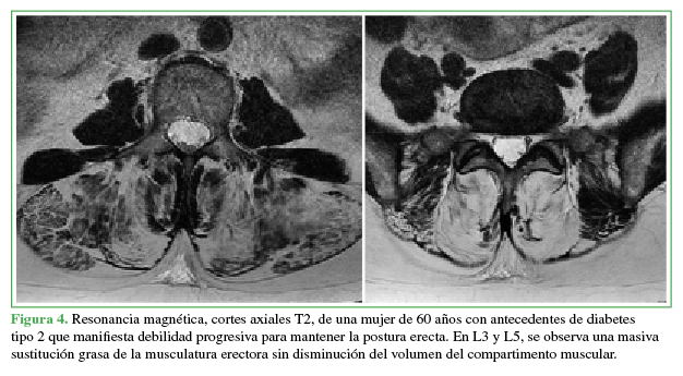 Resonancia magnética de cortes axiales T2 de una mujer de 60 años con antecedentes de diabetes tipo 2 que manifiesta debilidad progresiva para mantener la posición erecta.
