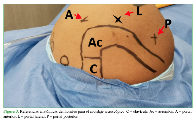 Referencias anatómicas del hombro para el abordaje artroscópico.
