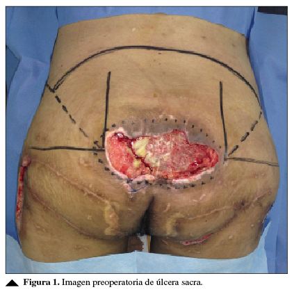 Imagen preoperatoria de úlcera sacra