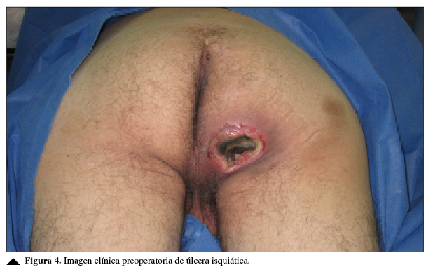 Imagen clínica preoperatoria de úlcera isquiática.
