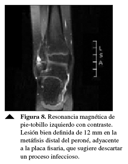 Resonancia magnética de pie-tobillo izquierdo con contraste.