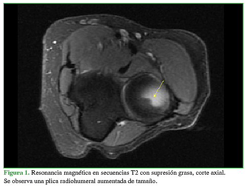 Resonancia magnética en secuencias T2 con supresión grasa, corte axial.