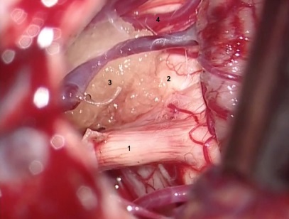 Visión quirúrgica microscópica. 
D)