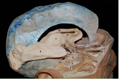 vista lateral de espécimen
anatómico donde fueron 
removidos ambos hemisferios cerebrales, y la duramadre del piso 
medio de la base de cráneo. Se expone el ganglio de Gasser y sus 
ramas.