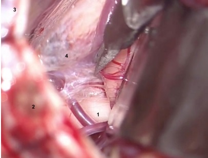 Visión quirúrgica microscópica. 
A) Disección cortante con microtijera.