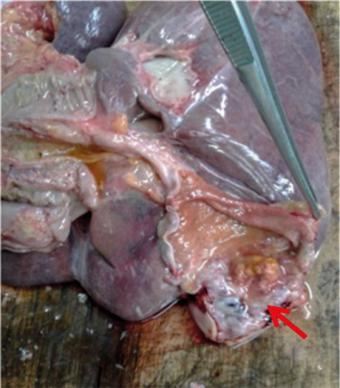 Exophytic
tumour towards the bottom of the gallbladder (arrow)