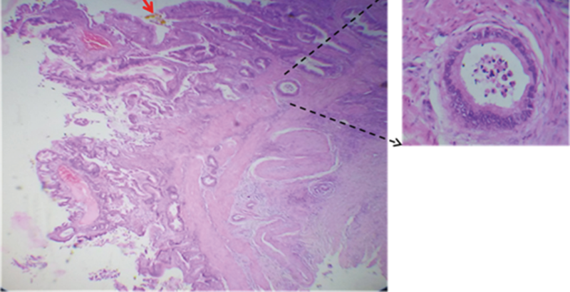 A. Moderately
differentiated adenocarcinoma infiltrating to the muscle layer.B. Papillary
formations towards the lumen.