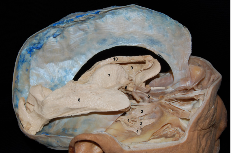 Lateral
view of anatomical specimen where both cerebral hemispheres and the dura mater
of the middle floor of the skull base were removed. Gasser’s ganglion and its
branches are exposed