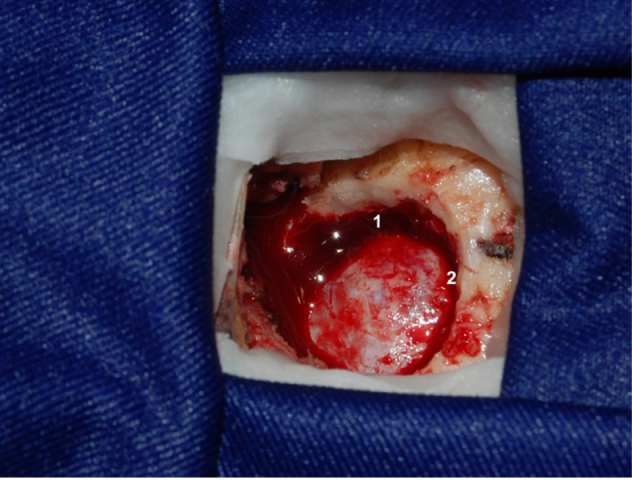 Left
asterional microcraniectomy.