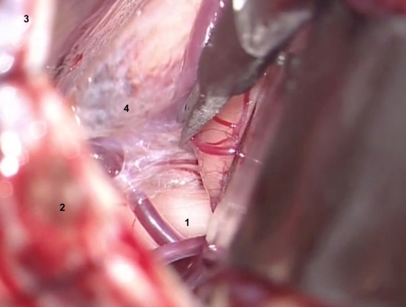 Microscopic
surgical view.  
A) Cutting dissection with microscissors.