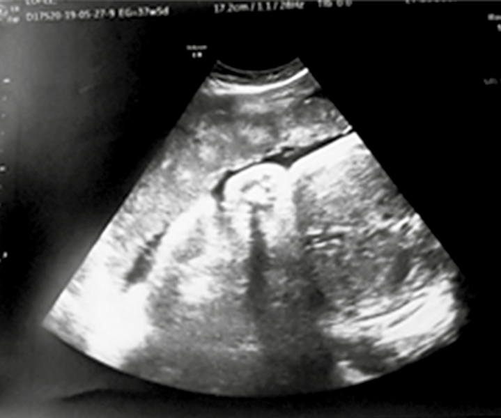 Anterior
placenta, not previa. Grade I.
