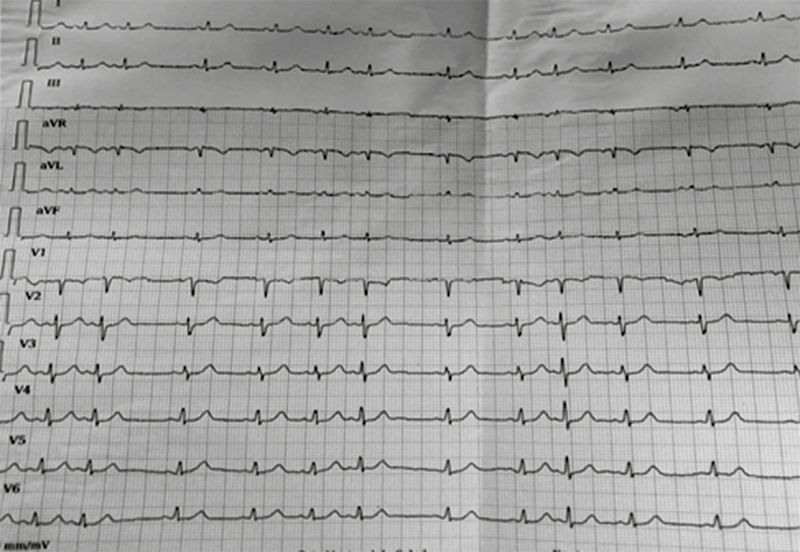 Patient’s
electrocardiogram