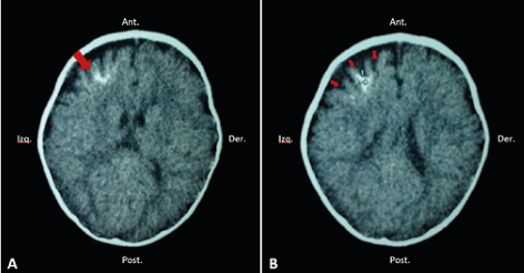 Corte axial de tomografía
computarizada (TC) sin contraste en un paciente con síndrome de Sturge-Weber,
donde se evidencia 
calcificación frontal izquierda de parénquima cerebral (flecha); estudio
imagenológico corresponde al paciente de la figura 1-B (A). Se 
puede evidenciar una atrofia cortical frontal (flechas) (B).