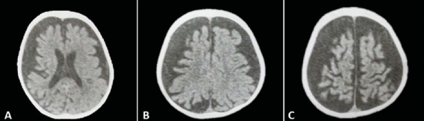 Tomografía computarizada (TC) sin contraste, correspondiente al
paciente de la figura 1-A. Se evidencia corte axial que muestra 
atrofia cerebral difusa; coincidiendo con el retraso psicomotor que presenta
este paciente con síndrome de Sturge-Weber.