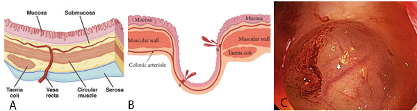 A) Representación de la pared normal
de colon. B) Pared de un diverticulo de colon con sangrado. C) Imagen
endoscopica de 
un diverticulo con estigma de sangrado observando a nivel de fondo diverticular