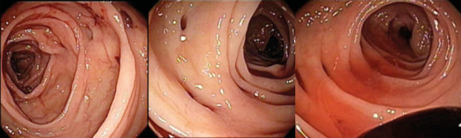 Primera colonoscopia donde se
observan múltiples divertículos en el trayecto del colon con coágulos en el
lumen, no se 
observa sangrado activo.