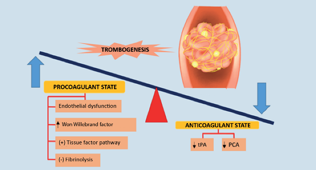 Pathophysiology of
coagulopathy in patients with COVID-19. The figure shows a dysregulation of
normal coagulation mechanisms, with a procoagulant state that favors thrombus
formation and thromboembolic complications. There is greater expression of
factors that favor coagulation such as Von Willebrand factor, activation of the
tissue factor pathway, inhibition of fibrinolysis and endothelial dysfunction;
on the other hand, there is less expression of anticoagulant factors such as
tissue plasminogen activator (tPA) and protein C (PCA)28,30.