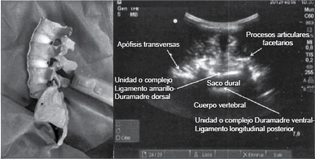Representation
of the intervertebral space in a transverse approach with all identifiable
elements. Cut allows to measure the distances between the skin and the yellow
ligament, as well as the continuity of the same image of a “flying bat”.