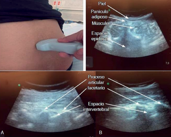  Transverse
approach showing the spinous process, laminae, common muscle mass, epidural
space and spinal canal. 7: Image at the L3-L4 level showing the anatomical
ultrasound differences between two volunteers. A female of 1.56m and BMI 28 and
7. B male of 1.70m and BMI 27.