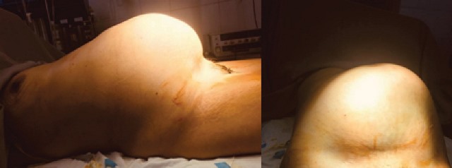 Appearance
of the abdominal tumor on clinical inspection