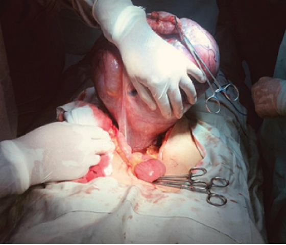Surgical
dissection of giant leiomyoma by means of a suprainfraumbilical median
incision.