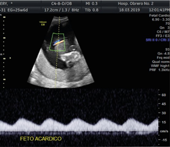 Doppler
demonstration of flow in the single umbilical artery to the acardiac fetus.
