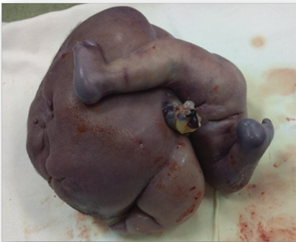 Amorphous
acardiac fetus weighing 2300 grams.