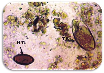 Heces
humanas en solución salina isotónica. Se aprecia, en un mismo campo, huevo de Trichuris trichiura (H Tt) a la izquierda y trofozoito
de Balantidium coli (T Bc) a la derecha. Objetivo de 40X. Imagen tomada por los
autores en Nabazanuka, enero 2018.
