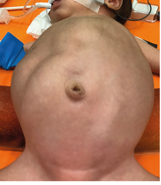  Examen del abdomen. Tumoración
visible y palpable en el flanco derecho del abdomen.  

 